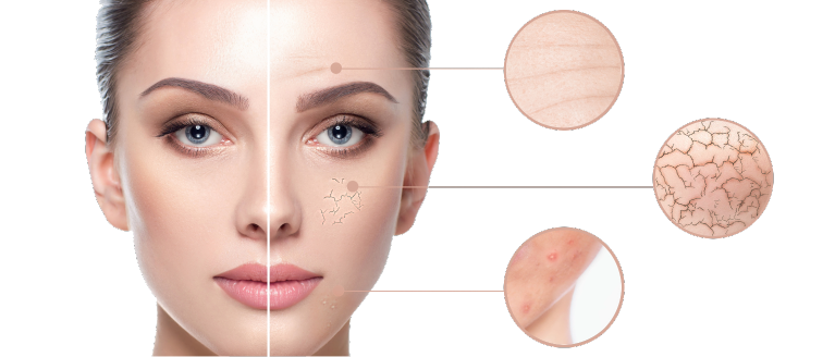 Split-view facial portrait of a woman, with the left side depicting healthy skin and the right side illustrating skin issues. Left Side (Healthy Skin): The woman has a smooth, clear complexion with a subtle glow, well-defined features, and a natural, healthy look. Right Side (Skin Issues): This side shows areas of concern, including visible dryness and fine lines, with indications of skin conditions such as cracks and blemishes. Close-Up Circles: Three circles highlight specific skin issues: the top circle shows a smooth patch, possibly representing healthy skin; the middle circle displays a dry area with a cracked surface; and the bottom circle features a red or blemished spot, indicating irritation or acne. The overall design contrasts healthy skin and common issues, emphasizing the importance of skincare and highlighting various skin conditions.