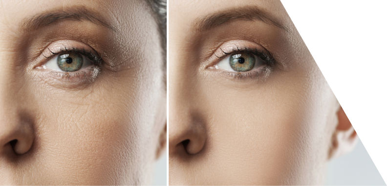 Split view of a woman's eye contrasting two different conditions of the skin around her eye. Left Side (Before): The skin appears textured with noticeable fine lines and wrinkles, indicating signs of aging, and has a slightly duller appearance with visible creases and a rugged texture. Right Side (After): The skin looks smooth and revitalized, free from wrinkles and featuring a more uniform tone, with the eye area illuminated, showcasing a healthy and youthful complexion. The split design effectively highlights the difference between aged skin and rejuvenated skin, emphasizing the impact of skincare treatments or interventions.